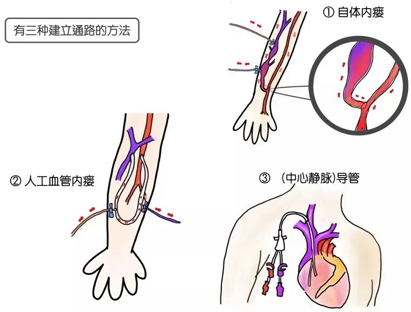 血管通路多學(xué)科診療模式，守護(hù)血透患者“生命線”