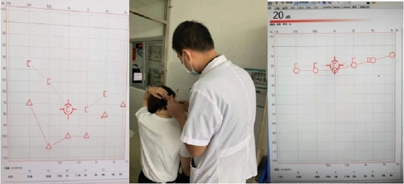突發(fā)性耳聾被治愈！萬載縣人民醫(yī)院成功開展耳后、鼓室內(nèi)給藥技術(shù)