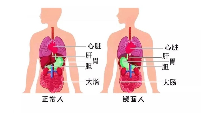 百萬分之一罕見“鏡面人”！五臟六腑反著長，手術(shù)也得反著來！