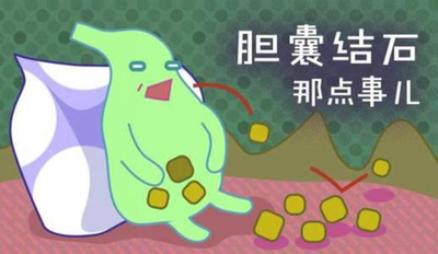 【健康科普】 膽囊結(jié)石 你知多少？