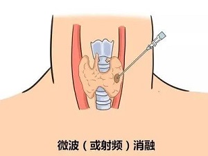 [三比三爭] 全縣獨家！我院成功開展甲狀腺微波消融術(shù)