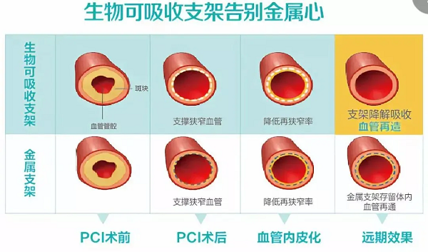 冠心病患者福音！我院成功完成首例可吸收支架植入！